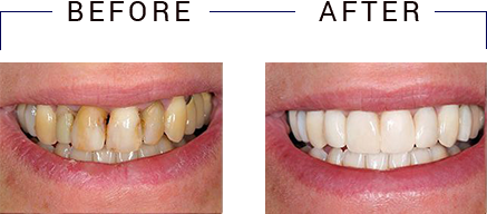 The image displays two photographs of a person's mouth with teeth before and after dental treatment, showing a significant improvement in oral health and appearance.