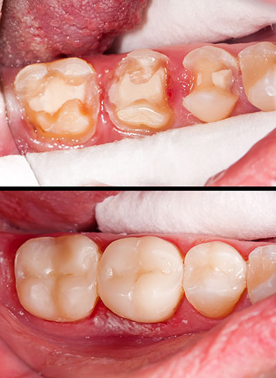 The image shows two photos of a person's mouth with teeth that appear to be decayed or damaged, likely for dental health education or treatment planning purposes.