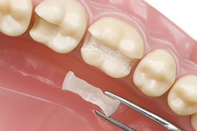 The image shows a close-up view of a dentist's work area with a tooth being prepared for a dental procedure, featuring a drill bit inserted into the tooth, and a small piece of material removed from the tooth.