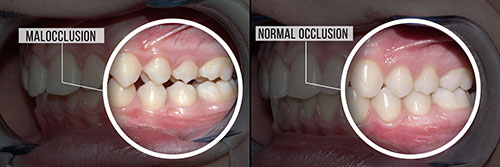 The image shows two photographs side by side of a person's mouth with teeth before and after treatment, labeled 'Malocclusion' and 'Normal occlusion,' respectively.