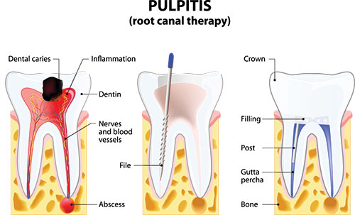 The image shows a diagrammatic representation of a dental implant procedure with annotations indicating various stages such as 'root canal therapy', 'dental caries', 'inflammation', 'crown', 'filling', and 'abscess'. It also illustrates the use of a blue tool, likely for cleaning or drilling, within the tooth structure.