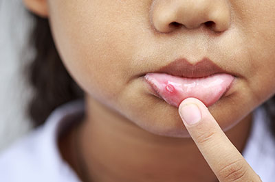 The image shows a close-up of a young individual's face with a focus on their lips, which appear to be affected by some form of irritation or condition, such as chapped or cracked skin.