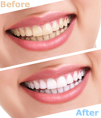 The image shows a smiling person's teeth before and after dental treatment, with a text overlay indicating improvement after the procedure.