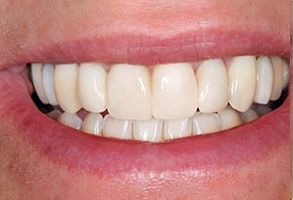 The image shows a close-up of a person's teeth with a bright smile, highlighting their dental hygiene.