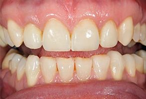 The image displays a close-up view of a person's mouth with teeth showing, revealing an oral health issue such as tooth decay or discoloration.