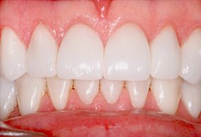 The image shows a close-up view of a person's teeth with a focus on the lower front teeth, which appear to be stained or discolored.