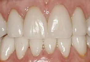 The image shows a close-up view of a person's teeth with a focus on the front teeth, which appear to be yellowed or discolored, possibly due to aging or staining.