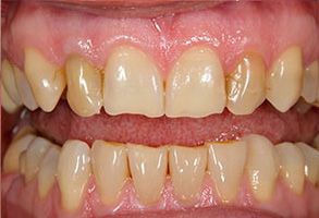 The image displays a close-up view of two sets of teeth with yellow stains, showcasing a before and after comparison likely for dental care services.