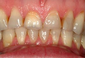 The image shows a close-up view of a person's teeth with visible staining and decay, emphasizing dental hygiene concerns.