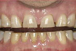 The image shows a close-up view of a person's teeth with visible signs of decay and staining, including yellowing and brown spots on the enamel.